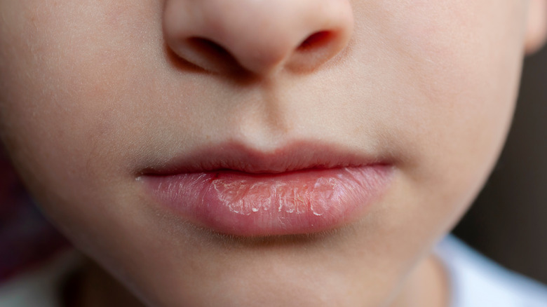 A woman with chapped lips